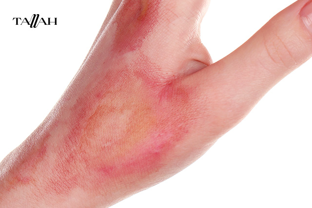 أفضل كريم للحروق من الدرجة الأولى