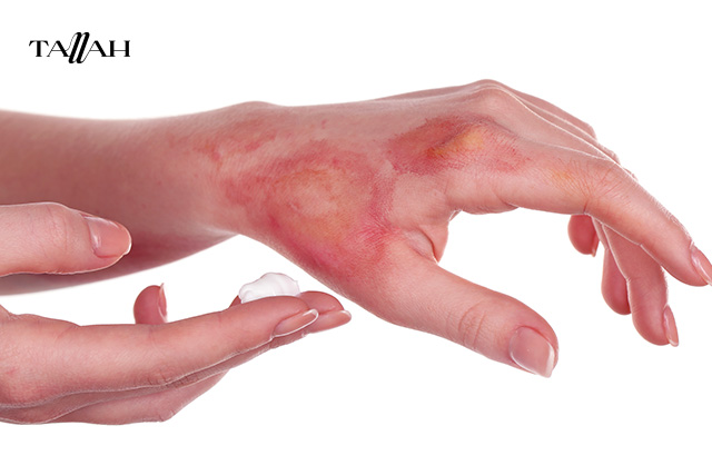 أفضل كريم للحروق من الدرجة الثانية