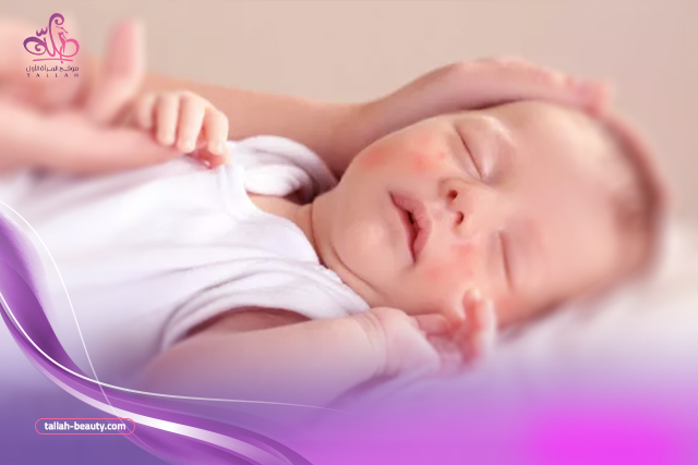 اعراض-حساسية-اللاكتوز-عند الرضع-