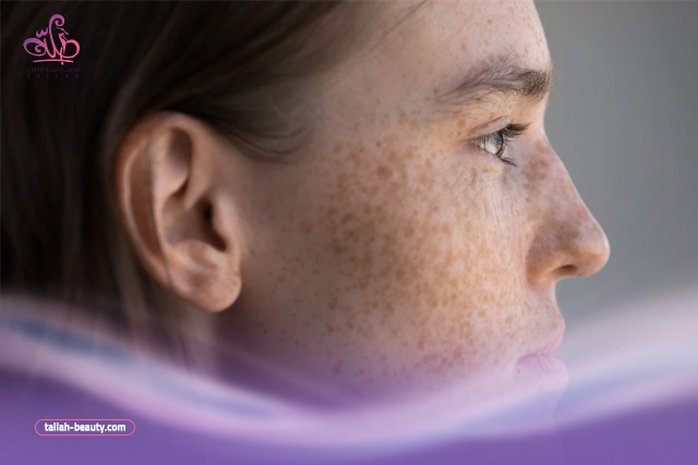 كيفية علاج تصبغات الوجه من الشمس