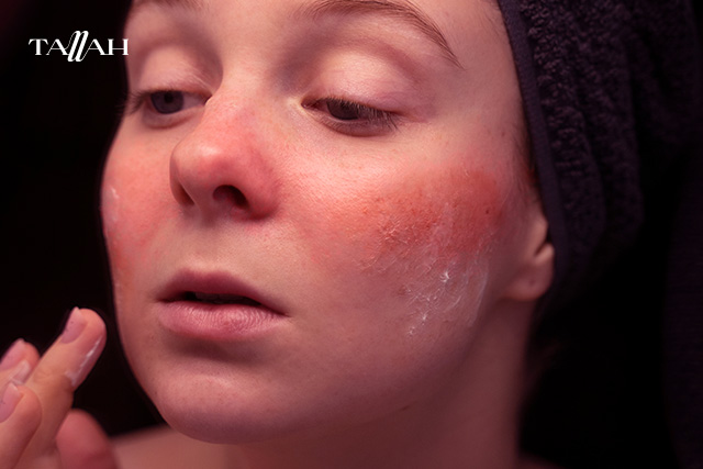 ماسك لعلاج حروق الشمس وتفتيح البشرة