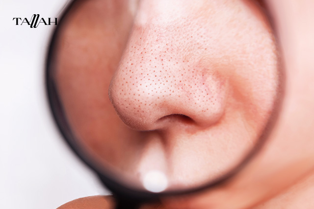 اسباب وعلاج البثور السوداء