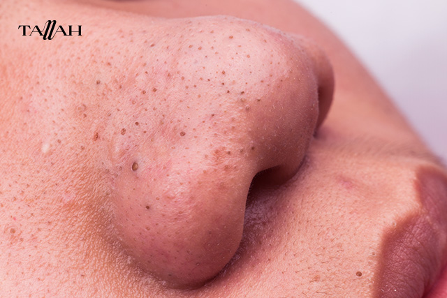 علاج البثور في الوجه