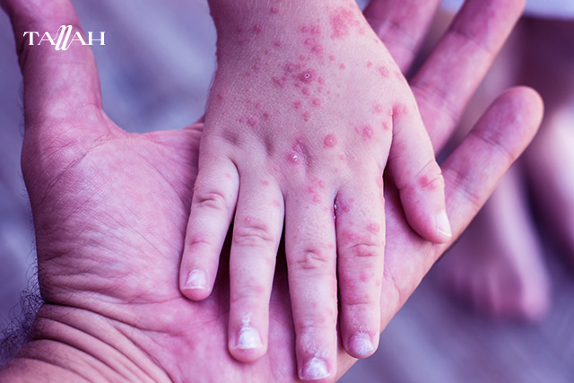 الفرق بين الجدري والحساسية