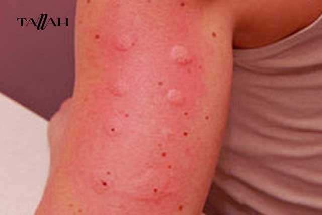 شكل حساسية الجلوتين