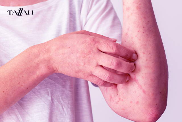 ازاي اعرف الجدري من الحساسية