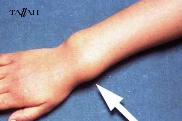 أشكال لين العظام عند الأطفال