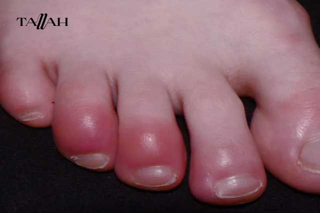 سبب تورم اصابع القدم في الشتاء