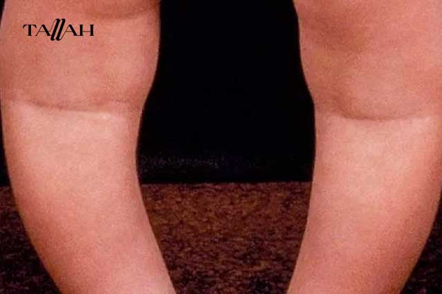 علامات لين العظام عند الرضع