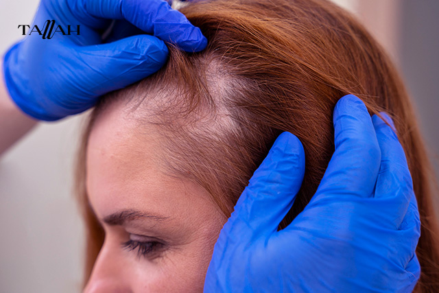 متى يتوقف تساقط الشعر الموسمي