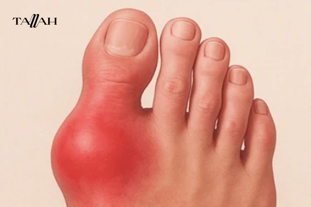 متى تكون نسبة النقرس عالية