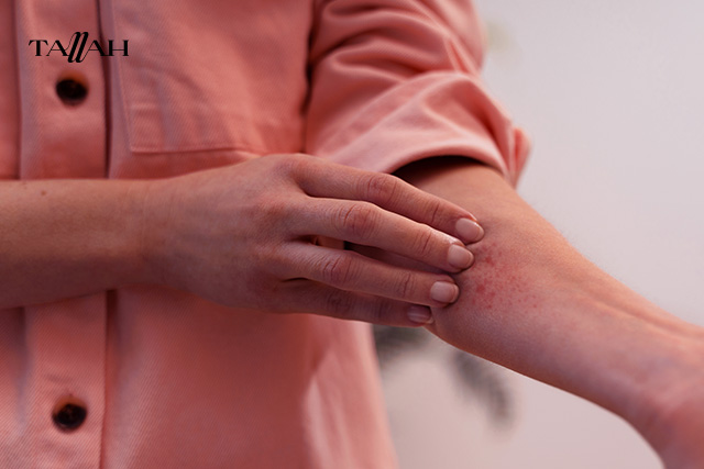 اعراض حساسية المانجو 