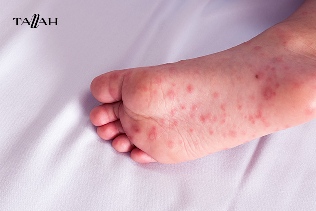 اسباب فيروس اليد والقدم والفم للاطفال