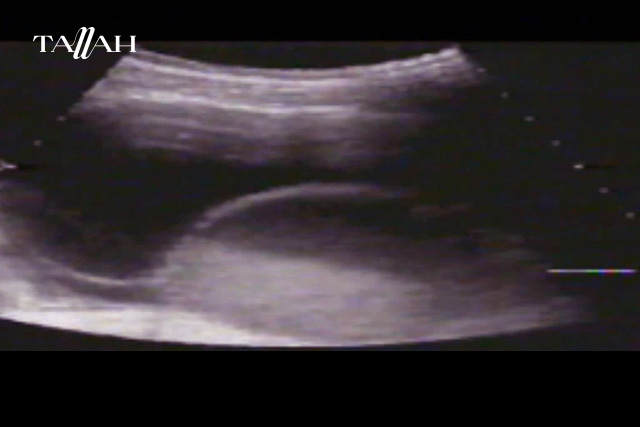 ما هي اعراض بطانة الرحم المهاجرة 