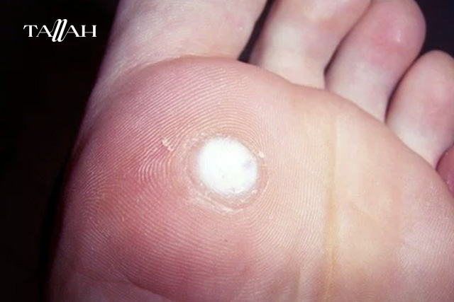 الفرق بين عين السمكة ومسمار القدم بالصور