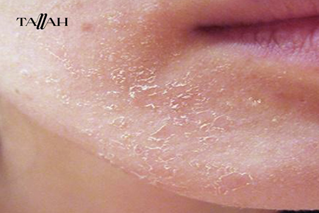 كيف أزيل قشور الوجه بعد التقشير