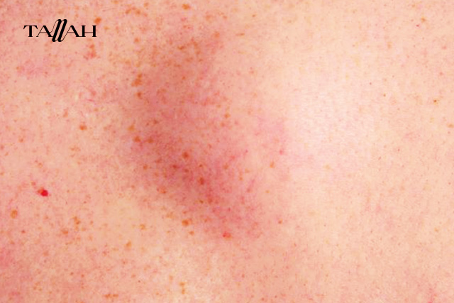 أعراض ارتفاع الدهون الثلاثية