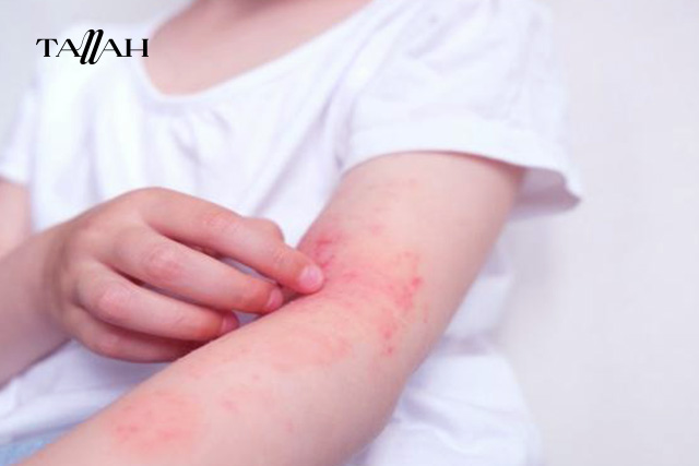 صور حساسية المانجو