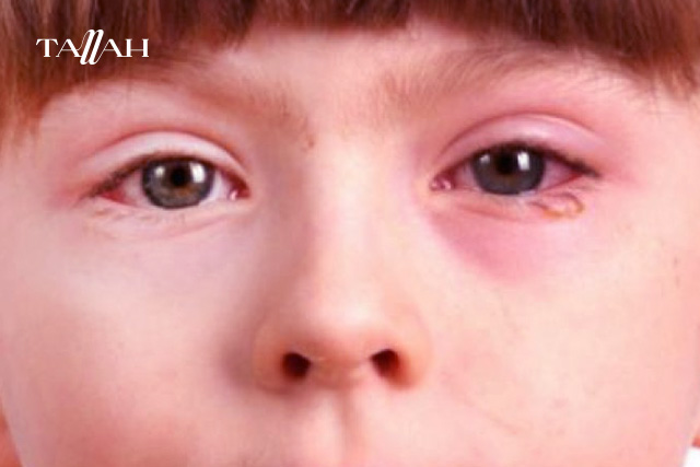 التهاب العين عند الاطفال