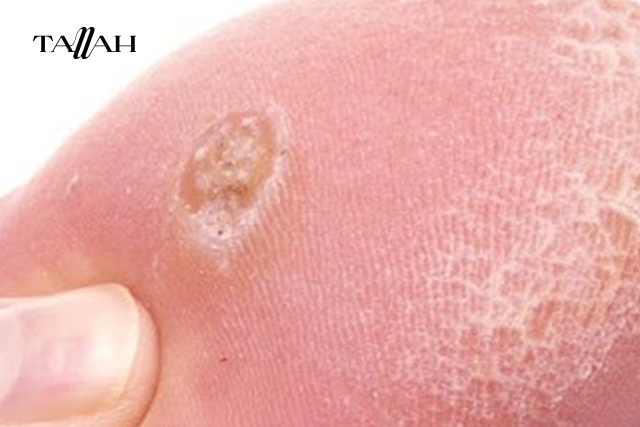  ازاي اعرف ان في رجلي عين سمكة؟