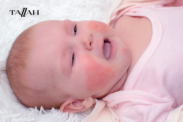 شكل حبوب حساسية الطعام عند الرضع