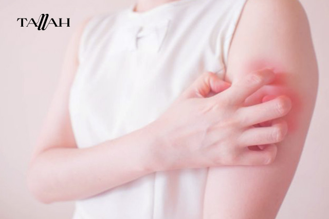 علاج حساسية المانجو في المنزل