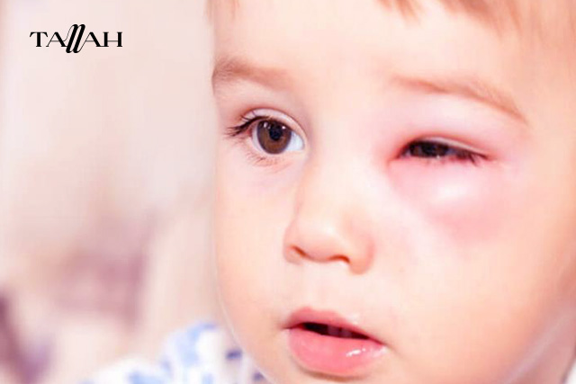 اعراض التهاب العين عند الاطفال