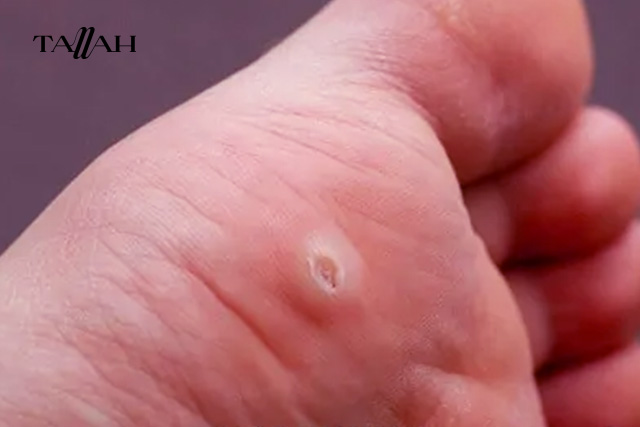 ازاى اشيل عين السمكه من رجلي في البيت؟