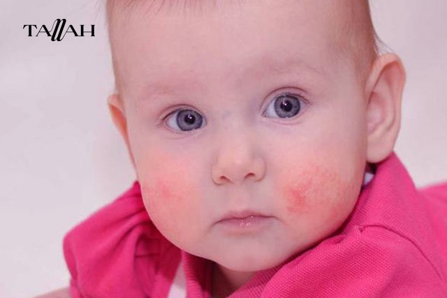 علامات حساسية الطعام عند الرضع