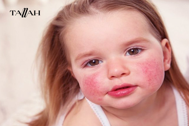 علاج حساسية المانجو عند الأطفال