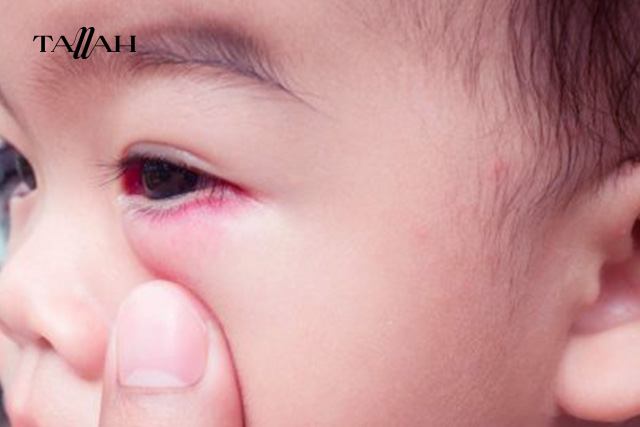 التهاب العين عند الاطفال بالصور