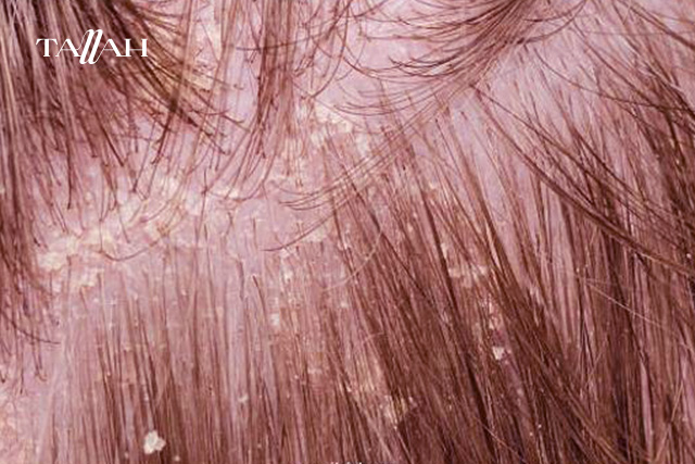 أنواع قشرة الشعر بالصور