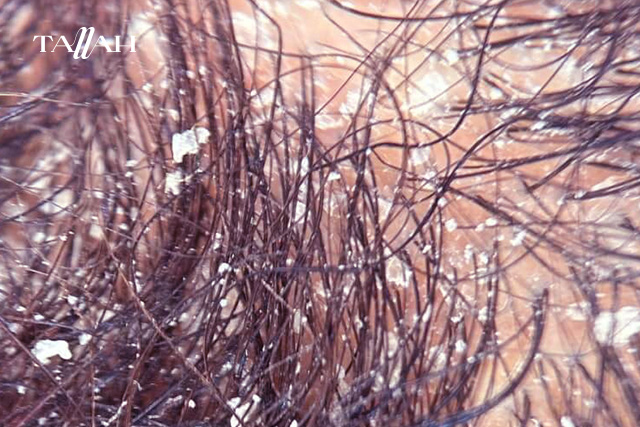 قشرة الشعر السميكة 