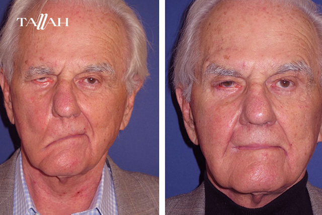 تمارين العصب السابع بالصور