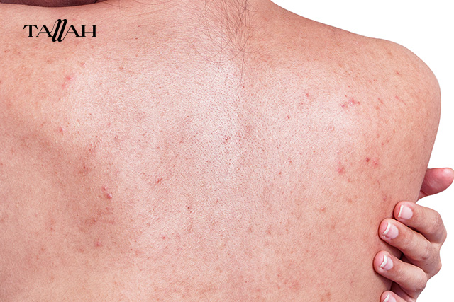 طريقة إزالة شعر الظهر بنفسك