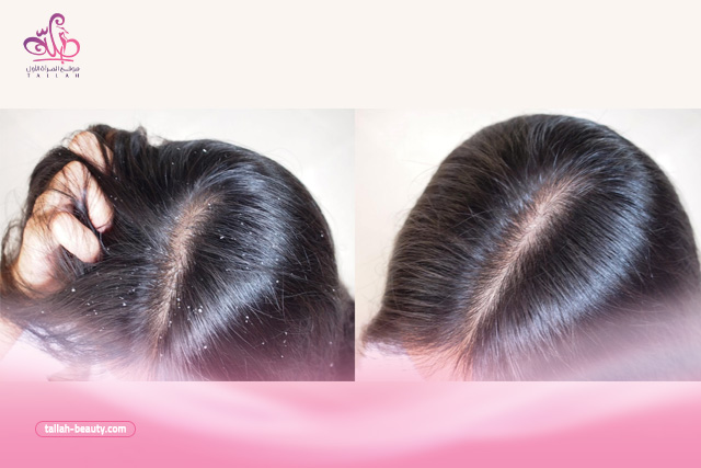 أفضل الطرق لعلاج قشرة الشعر نهائيًا