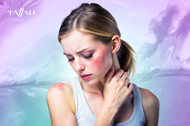 أفضل كريم لعلاج حروق الماء الساخن