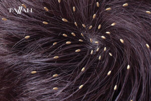 علاج القمل في يوم واحد 