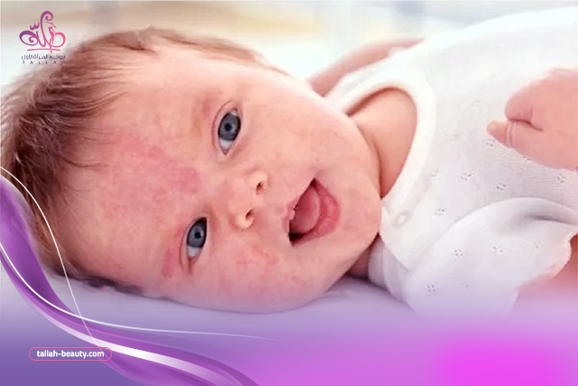 حساسية-اللاكتوز-عند-الرضع والرضاعة-الطبيعية-