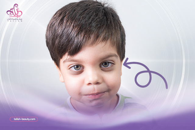 الهالات-السوداء-عند-الاطفال