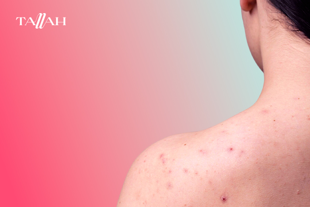 أسباب ظهور الحبوب في الظهر عند النساء وطريقة علاجها