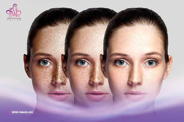 طرق علاج تصبغات الوجه في المنزل