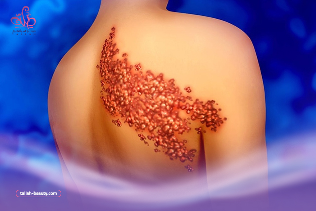 شكل الحزام الناري في بدايته: