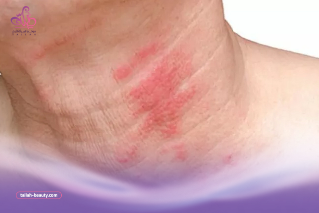 علاج-الحزام-الناري