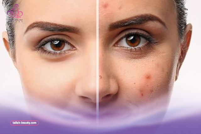 ريفيو عن مرطب ديرما اكتيف للبشرة الدهنية