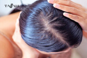 أعراض التهاب فروة الرأس