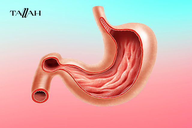 عملية تكميم المعدة