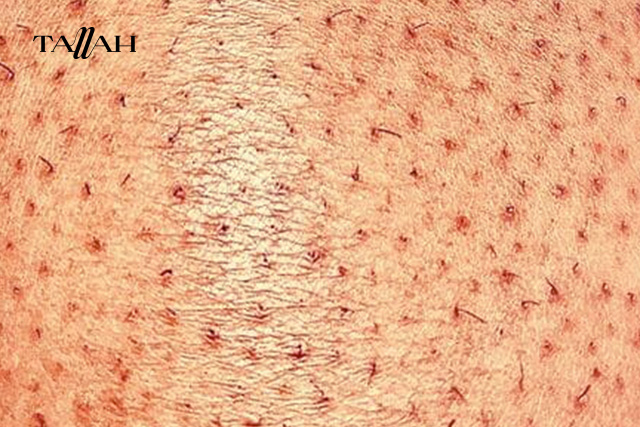 للتخلص من جلد الوزة في الساقين