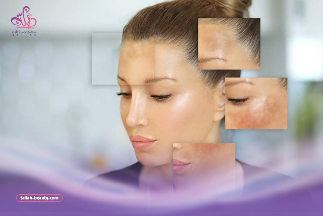 10 طرق لعلاج الكلف في الوجه