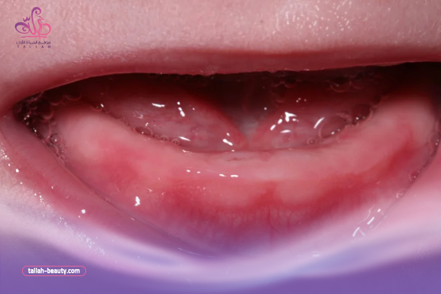 أعراض التسنين عند الأطفال